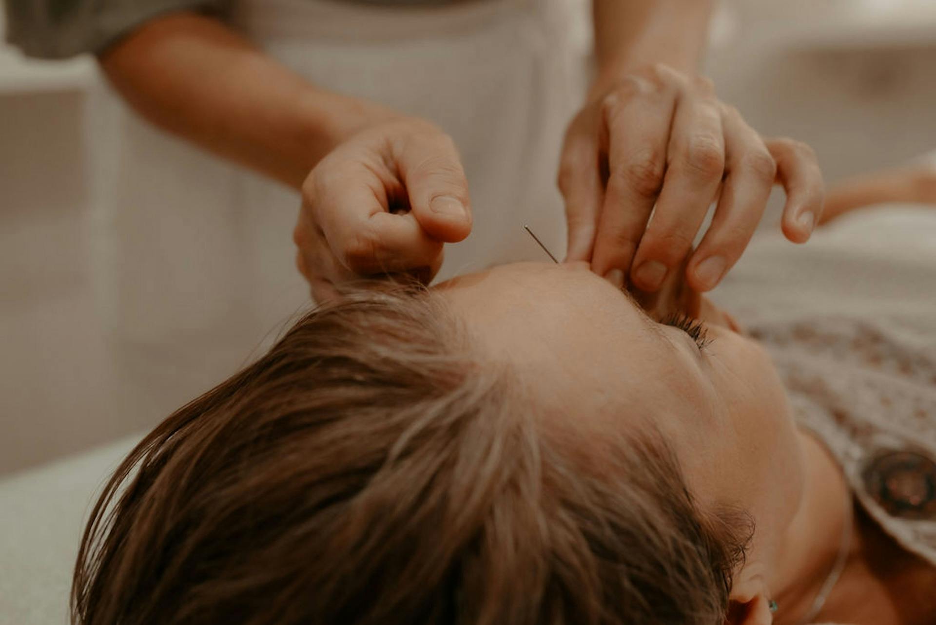 Acupuncturist puts in a small acupuncture needle into the forehead, the point in called yin-tang